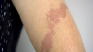 Port Wine Stain Birthmark - Children’s Skin Center - Florida