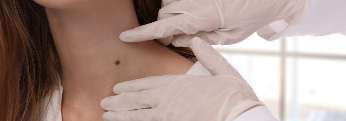 Birthmark - Childrens Skin Center