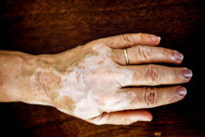 Vitiligo