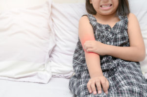 psoriasis in children