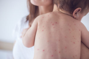 Chickenpox