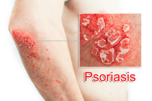 Psoriasis in Children