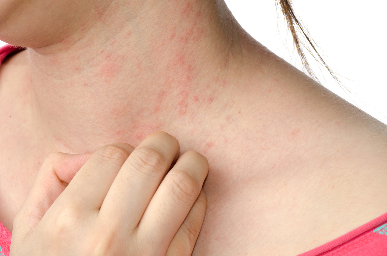 Heat Rash or Prickly Heat (Miliaria Rubra) Condition, Treatments