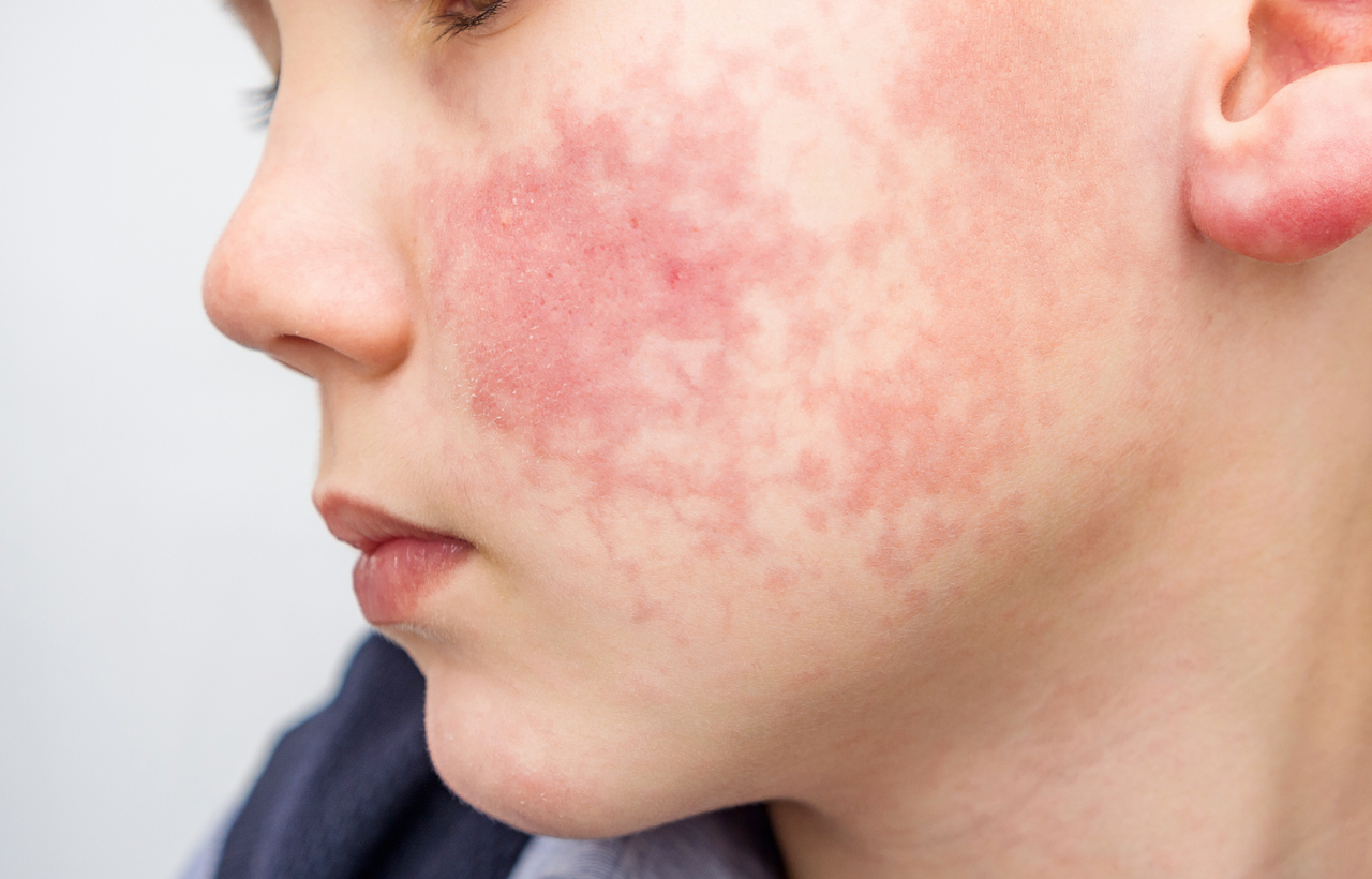 Types of Skin Rashes  Children's Skin Center PA