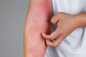 Closeup of skin rash on child's arm.
