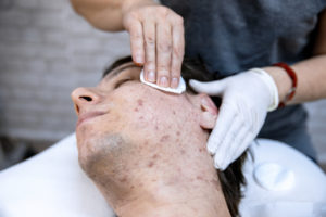 Doctor treating man with acne