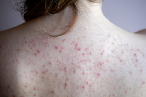 A teenage girl with acne on her back who is in need of a cosmetic dermatologist.