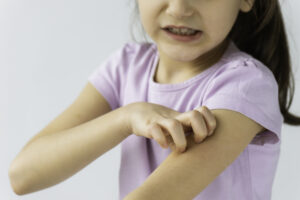 A girl child is suffering with eczema