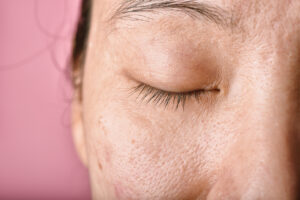 Dark Spot treatment by Dermatologist