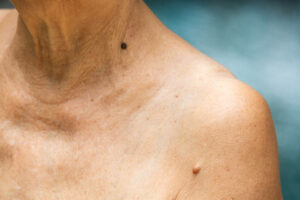 Senior woman have Brown mole on brachium, Black mole on neck , Medicine, Close up