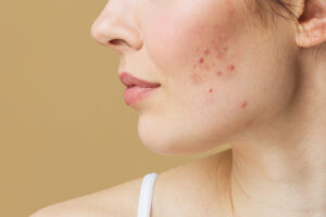 Young woman before and after acne treatment