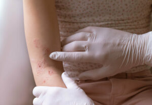 Pediatric Dermatologist hands examining eczema