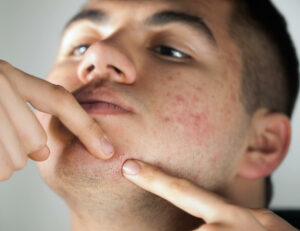 male person popping a pimple