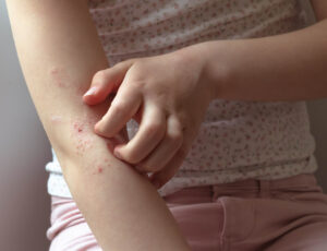 Eczema In Children