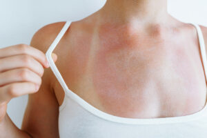 Woman showing off her sunburn before booking an appointment with her local skin doctor in Miami.