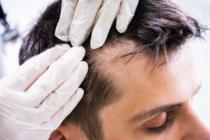 A dermatologist is examining a patient's hair to assess hair loss.