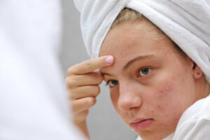 A teenage girl is examining the acne on her face in the mirror.