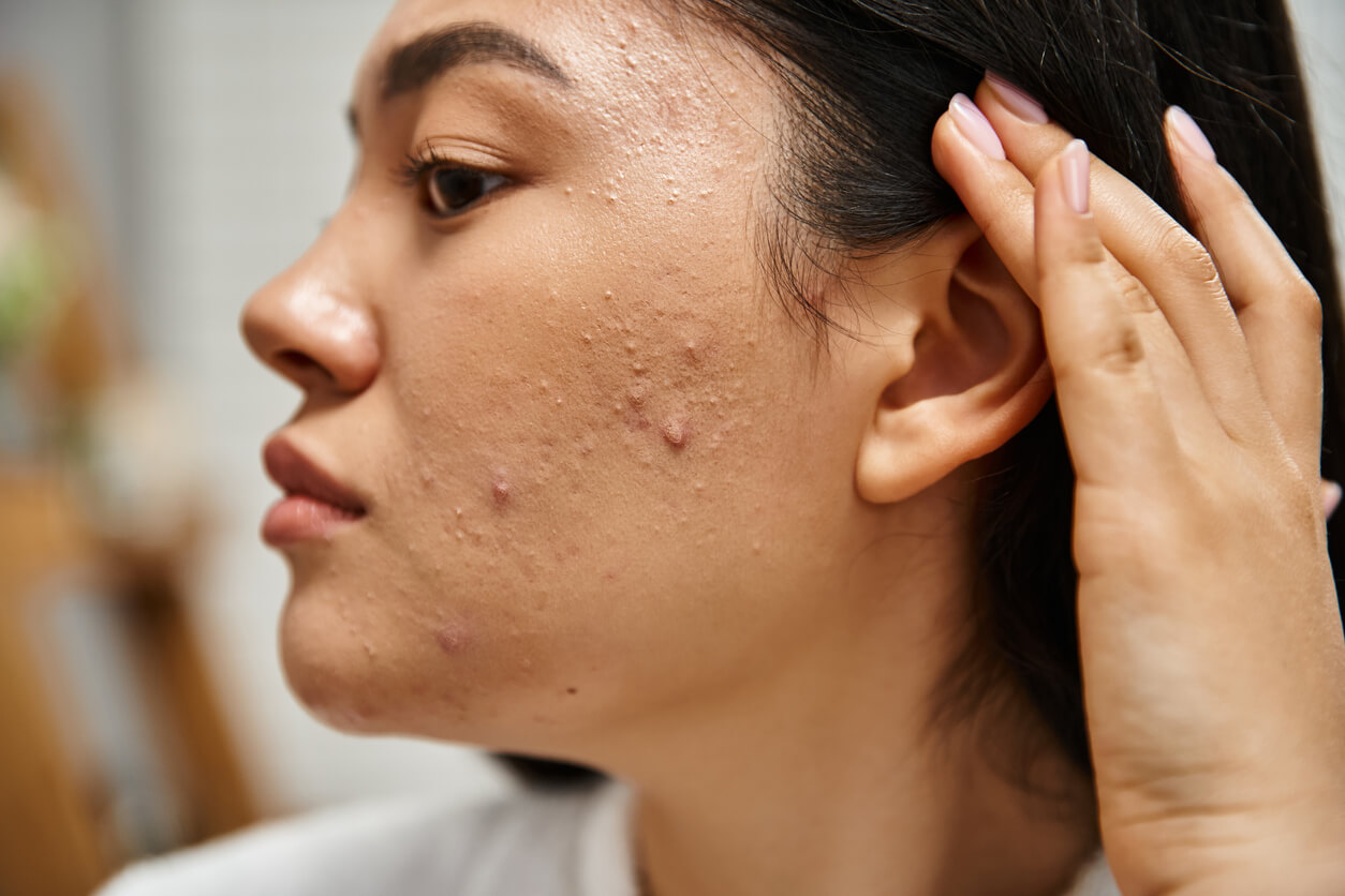 Best Skin Treatments for Sensitive Skin and Acne