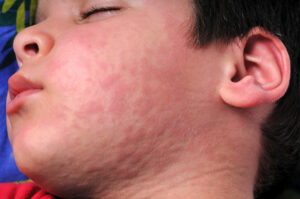 Urticaria Skin Rashes on Face of a Child.