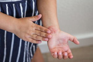 Close-up of child s hands with red irritated skin atopic dermatitis and eczema on the wrist.