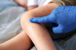A Pediatric Dermatologist is examining child with bodily red rash.